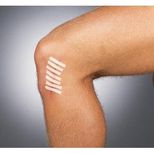 Derma Sciences Suture Strip Wound Closure Strips